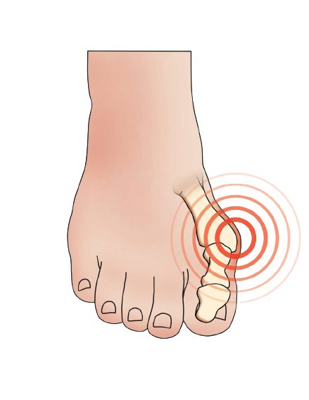 Ailments-Bunion-removebg-preview.png
